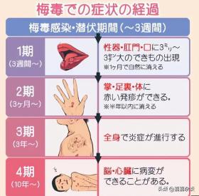 日本梅毒病例激增 東京市政府出手！注意了，在日或者旅日的朋友